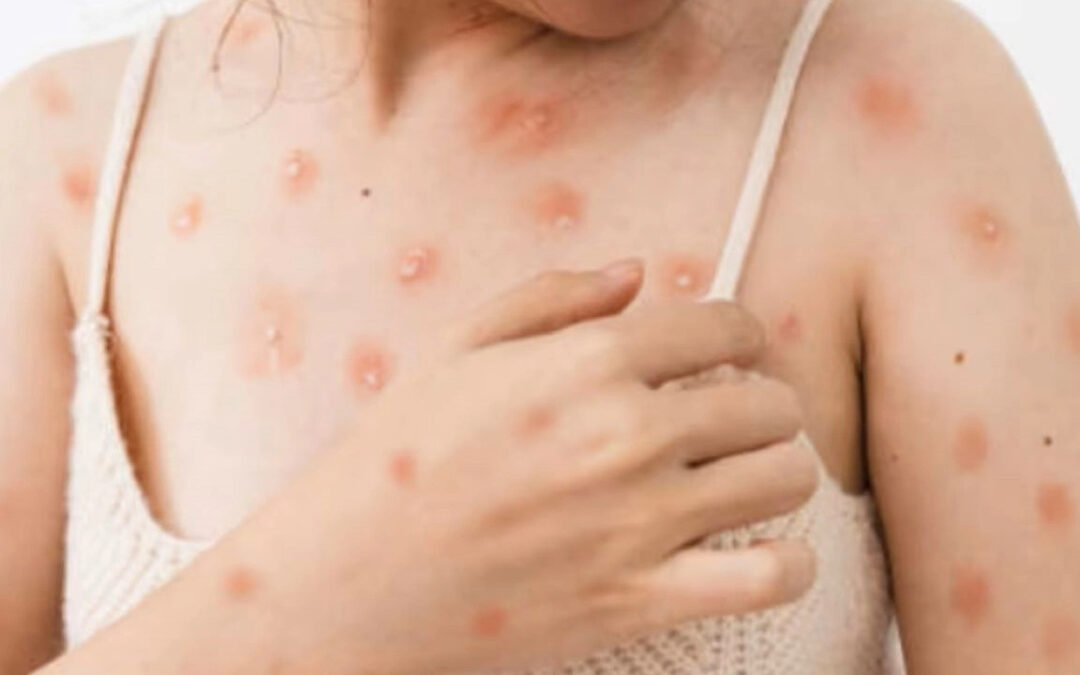 Europa eleva el nivel de alerta por mpox tras caso detectado en Suecia